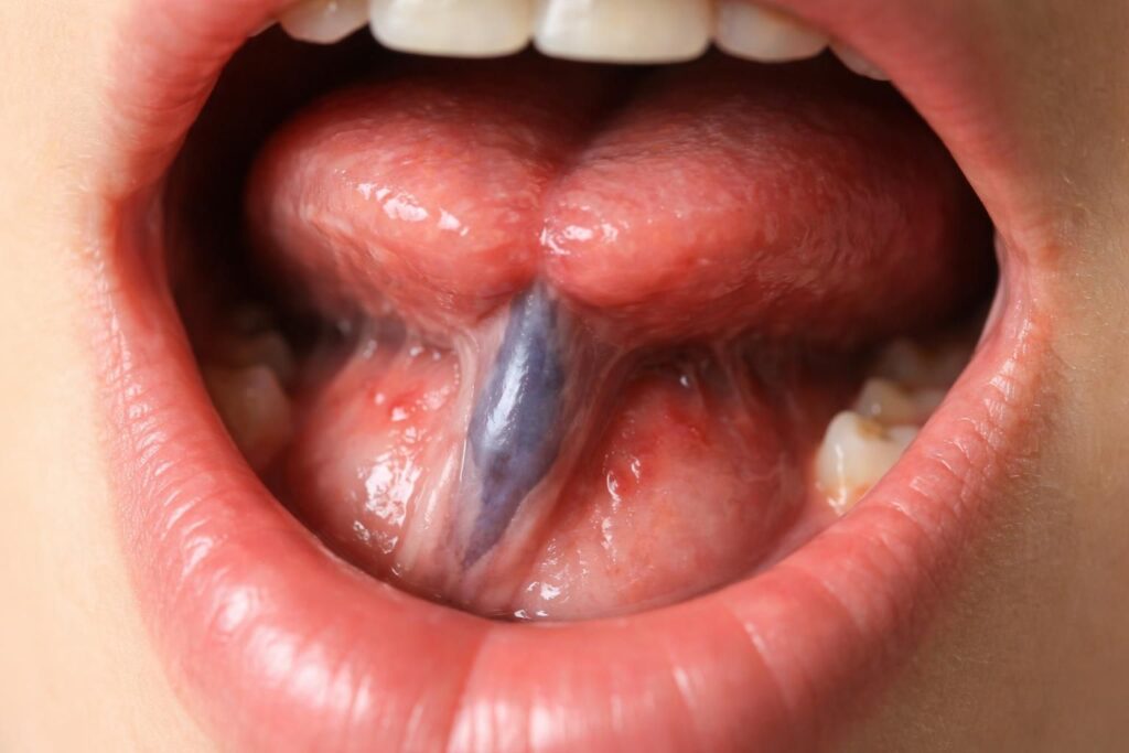 découvrez les principales causes d'une veine enflée sous la langue, leurs symptômes et les traitements possibles pour soulager cet inconfort buccal.