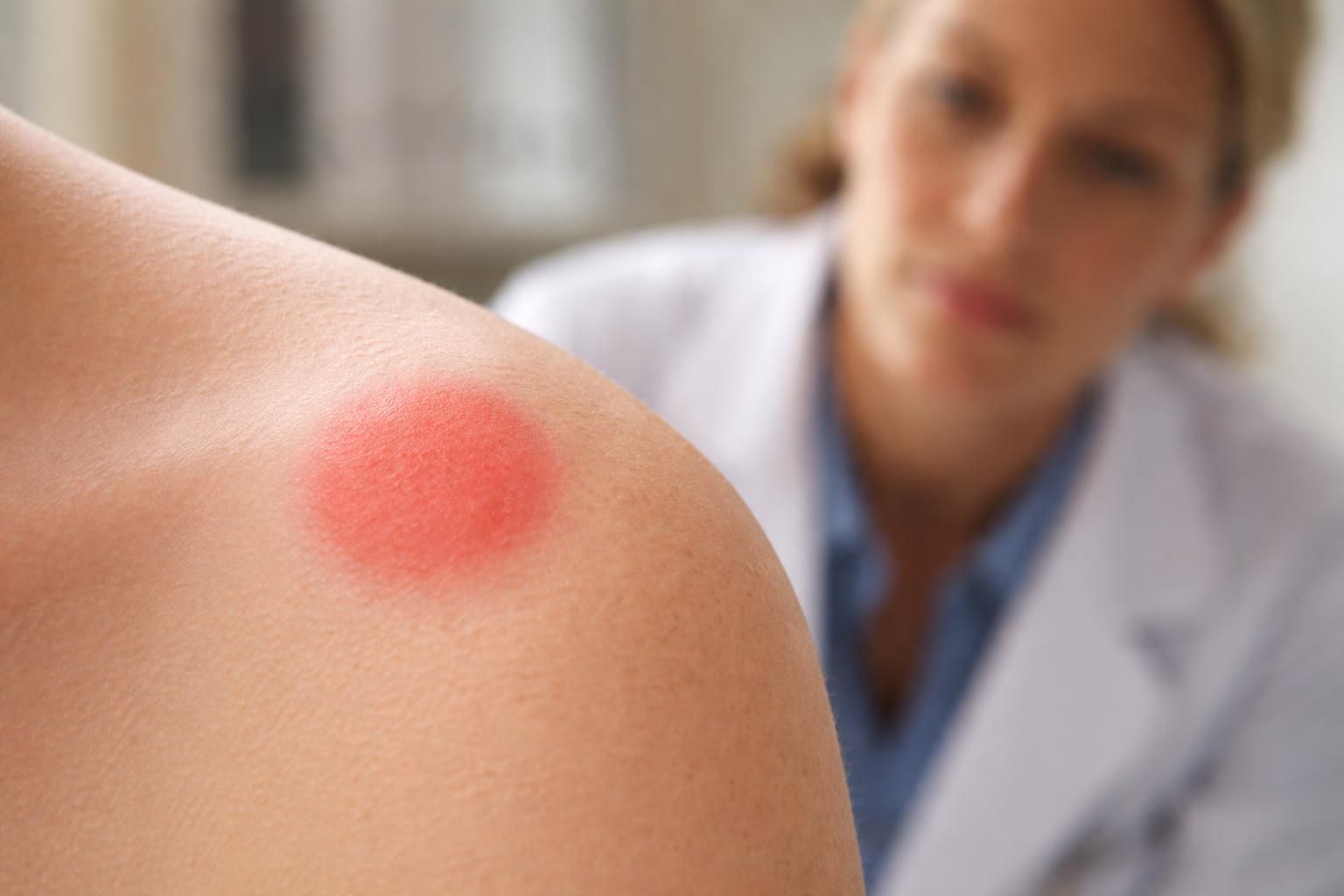 découvrez quand une tache rouge sur la peau sans démangeaison nécessite une consultation chez le dermatologue et comment reconnaître les signes d'alerte pour agir rapidement.